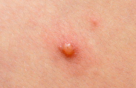 Molluscum contagiosum - Hình ảnh minh họa
